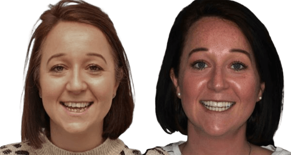 Lisa's Invisalign before and after results